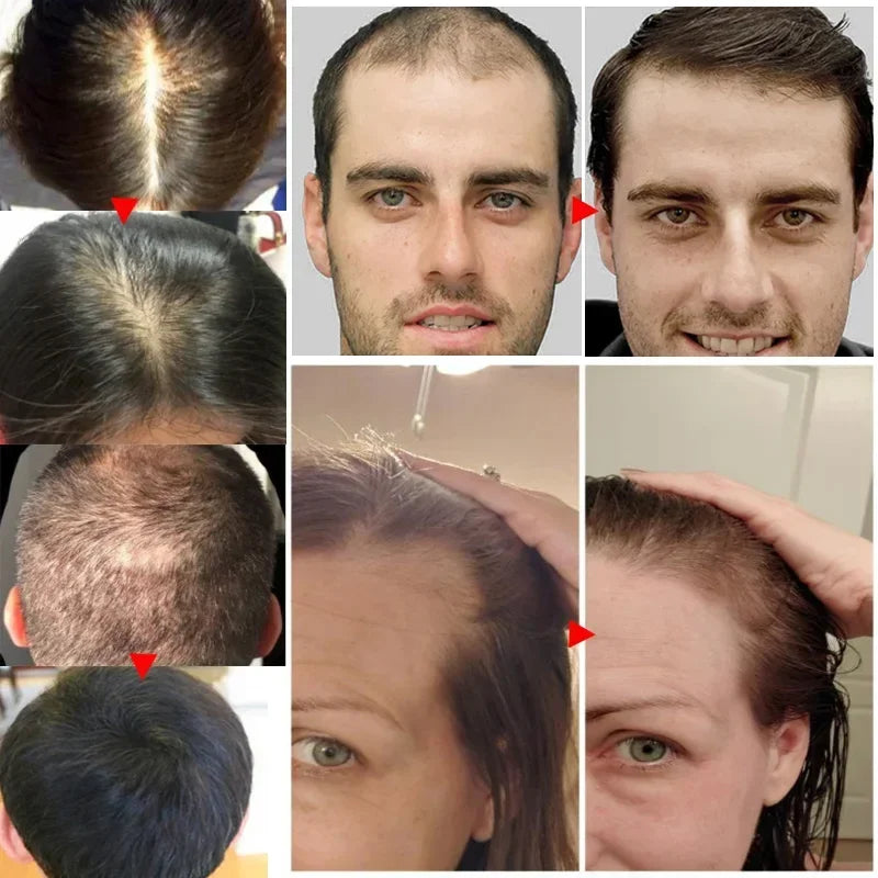 Ginger Hair Growth Essential Oil Anti-Loss Hair Regrowth Serum Fast Growth Prevent Baldness Treatment Alopecia Hair Care Product