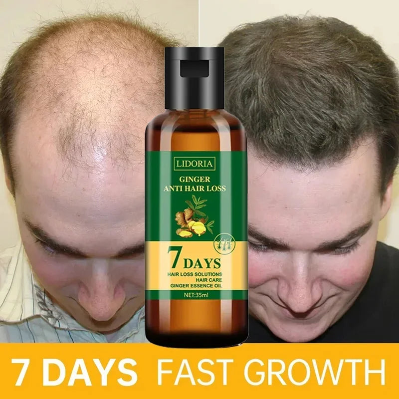 Ginger Hair Growth Essential Oil Anti-Loss Hair Regrowth Serum Fast Growth Prevent Baldness Treatment Alopecia Hair Care Product